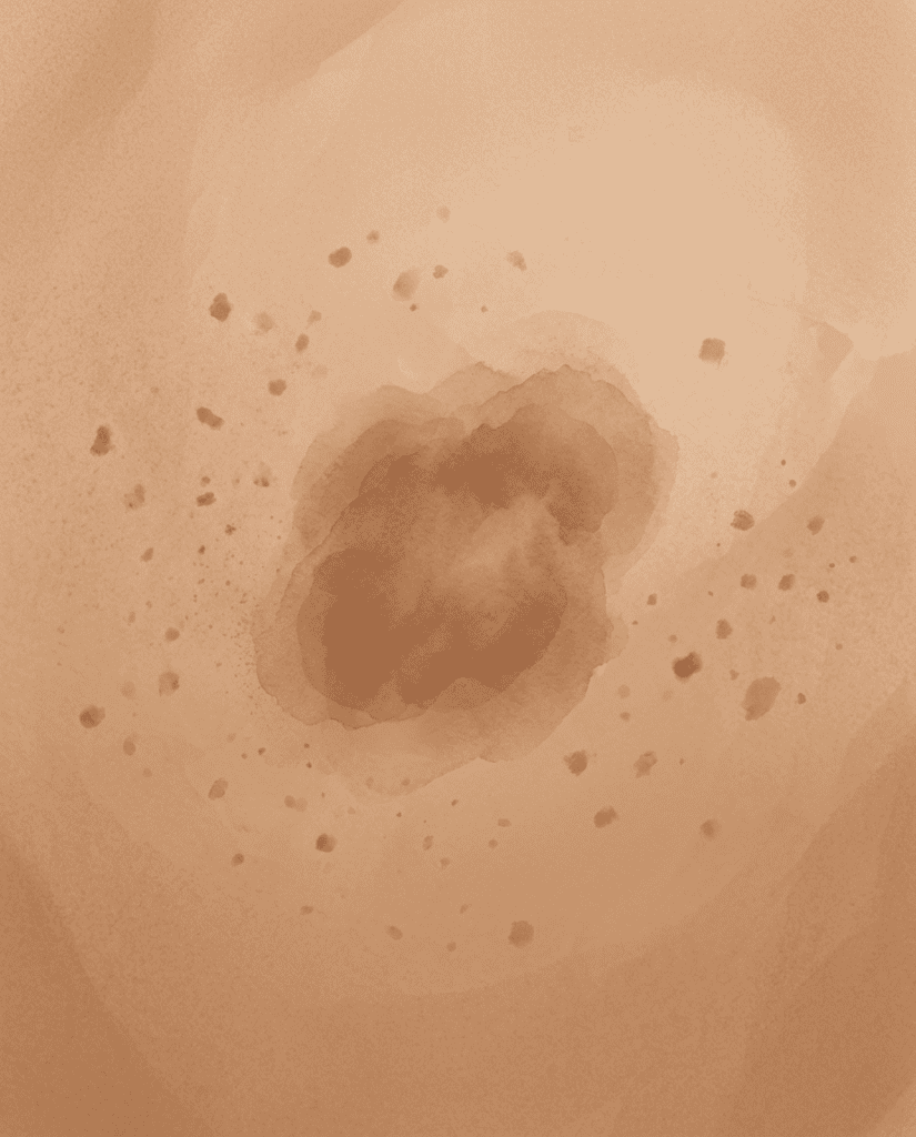 Watercolour illustration of skin with freckles and an area of deeper pigmentation.