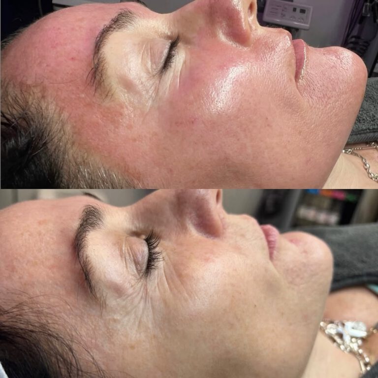 Before and after close-ups of a client’s cheek, in profile.