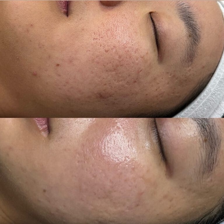 Before and after close-ups of a cheek with acne scarring.