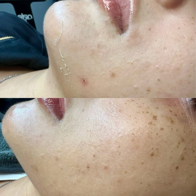 Before and after close-ups of the chin and jaw.