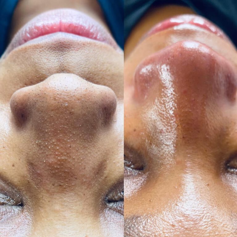 Before and after close-ups of the nose and chin area.
