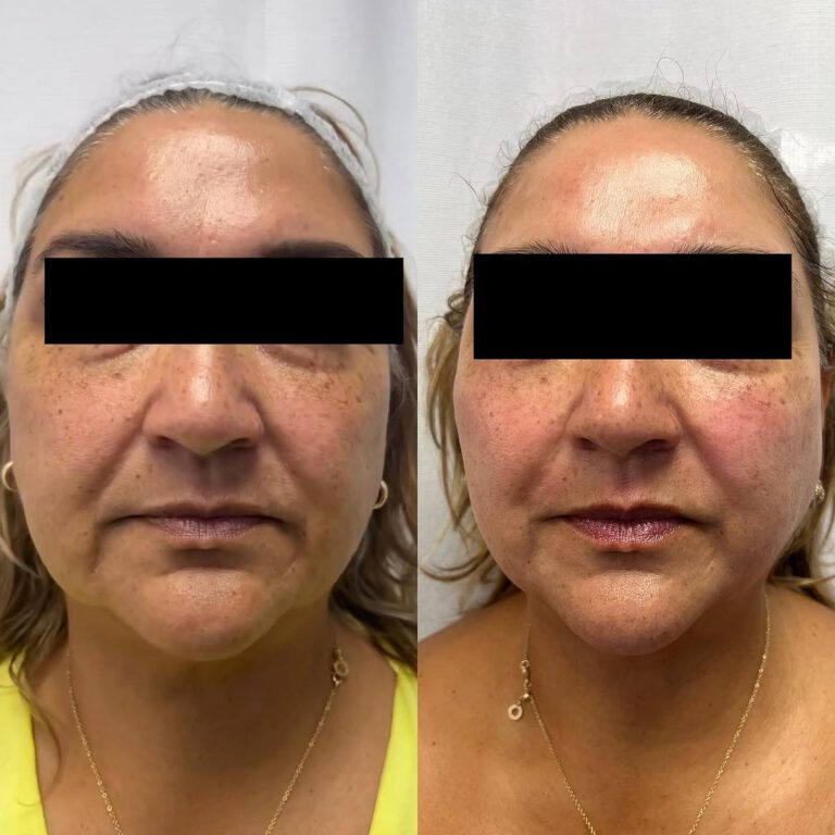 Before and after photos of the same client, front view, six weeks apart.