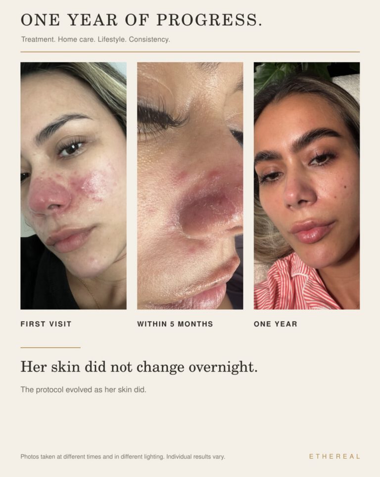 One year of progress: the same client at her first visit, within five months and at one year, with visibly less redness.