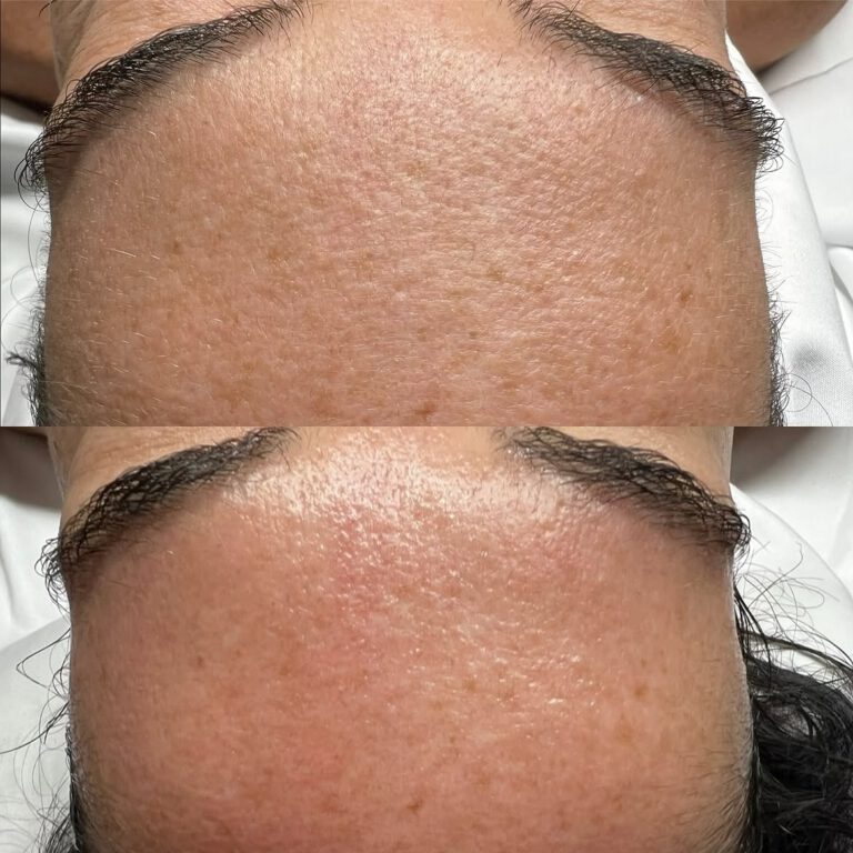 Before and after close-ups of forehead texture.