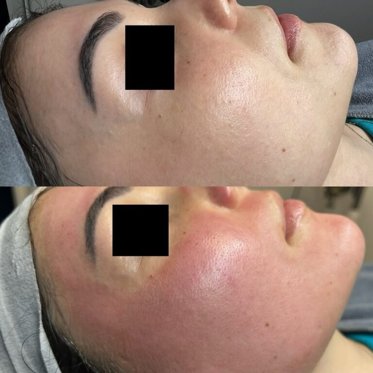 Two close-ups of a client’s cheek in profile, before and after treatment.