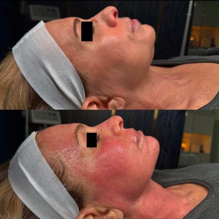 A client’s face in profile before treatment and immediately after, showing temporary redness.