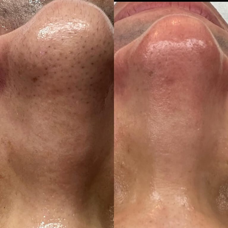 Close-ups of the nose before and right after extractions.