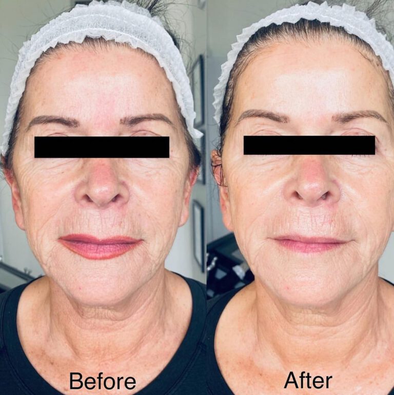 Before and after photos of the same client, front view.
