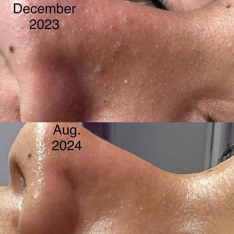 Close-ups of the nose and cheek in December 2023 and August 2024, showing clearer, more hydrated skin.