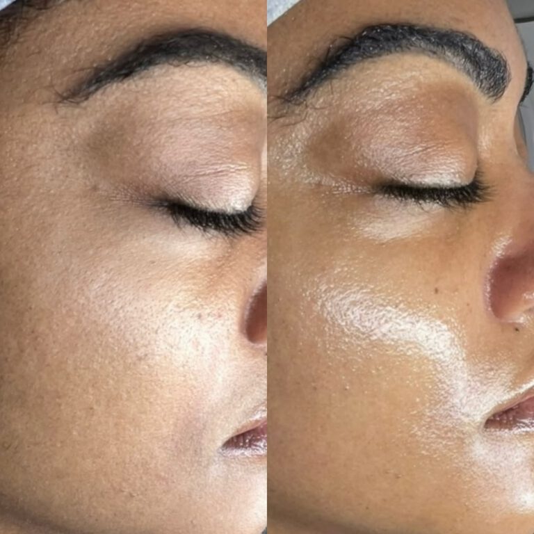 Side-by-side close-ups of the eye and cheek area, before and after, with a smoother, more hydrated surface.